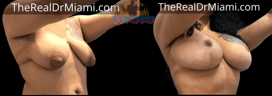 Before-and-after views for Breast Lift, Case 84.