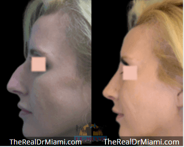 Before-and-after views for Rhinoplasty, Case 104.