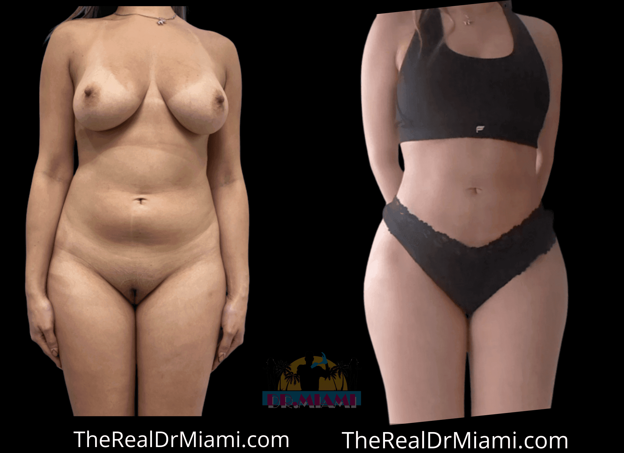 Before-and-after views for Brazilian Butt Lift, Case 121.