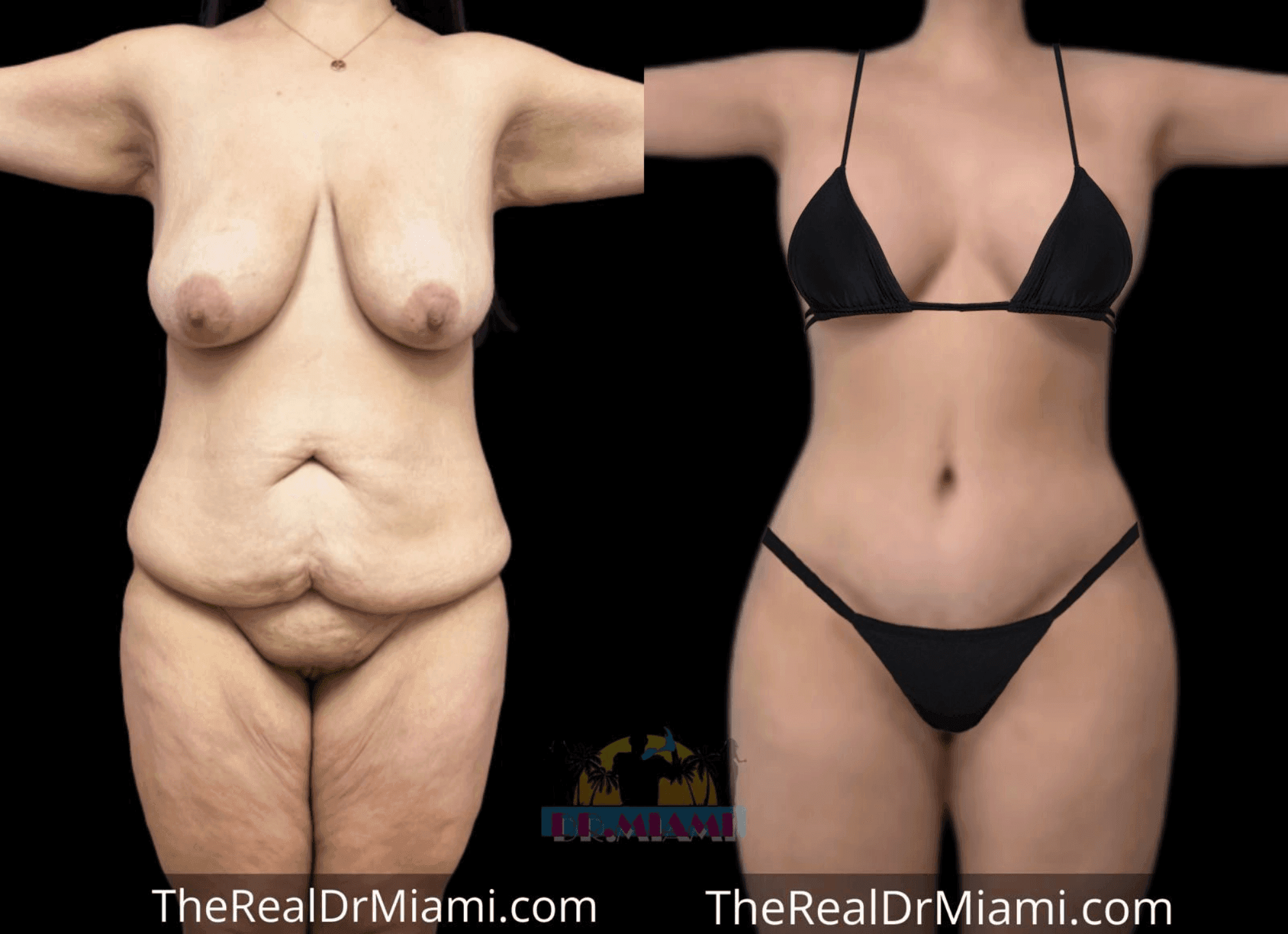 Before-and-after views for Mommy Makeover, Case 59.