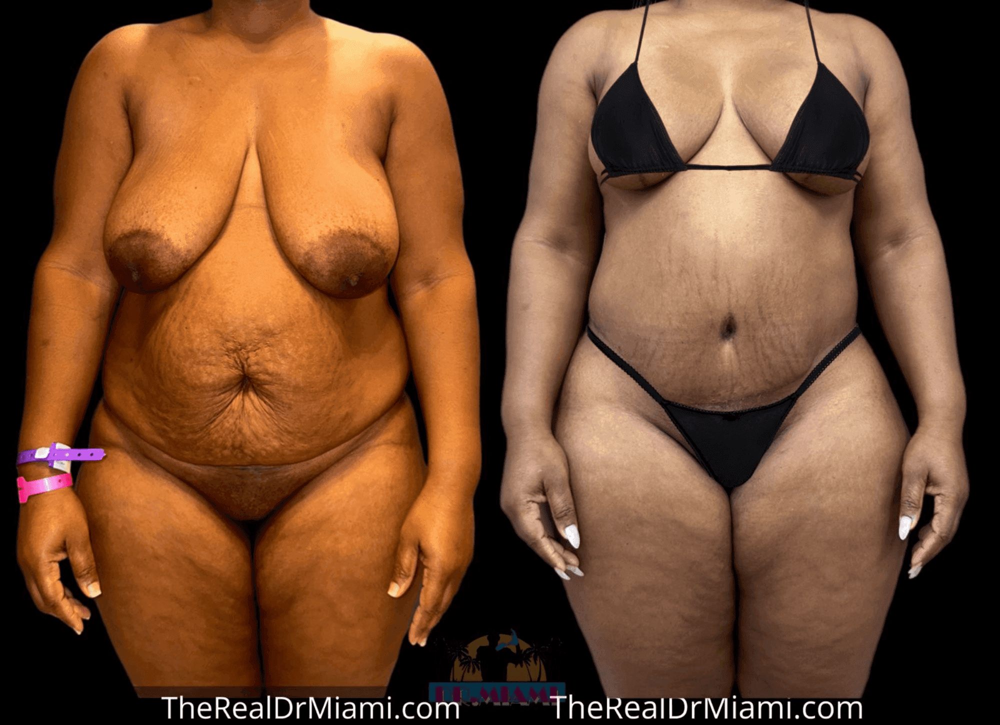 Before-and-after views for Mommy Makeover, Case 35.