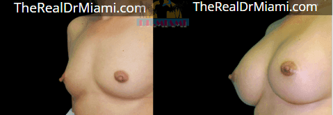Before-and-after views for Breast Augmentation, Case 108.