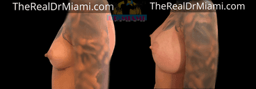Before-and-after views for Breast Augmentation, Case 76.