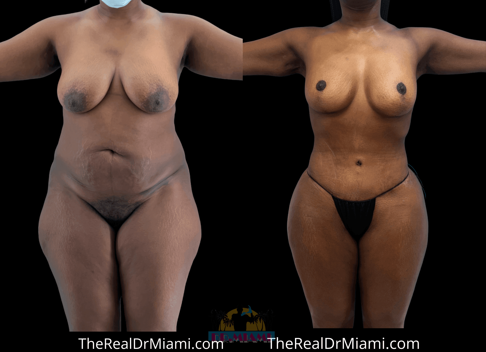 Before-and-after views for Mommy Makeover, Case 127.