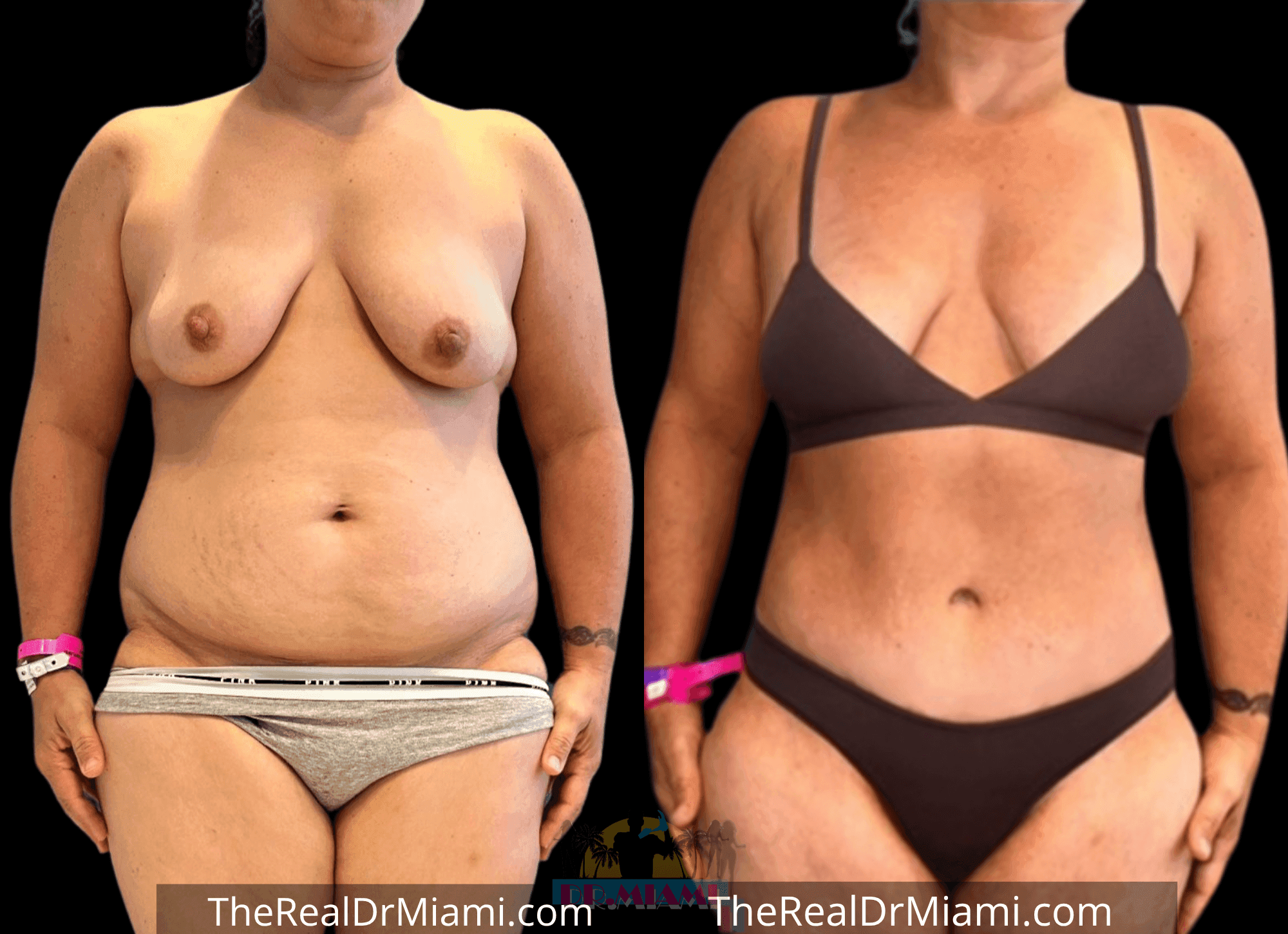 Before-and-after views for Tummy Tuck, Case 66.