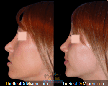 Before-and-after views for Rhinoplasty, Case 101.