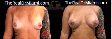 Before-and-after views for Breast Augmentation, Case 31.