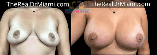 Before-and-after views for Breast Lift, Case 67.
