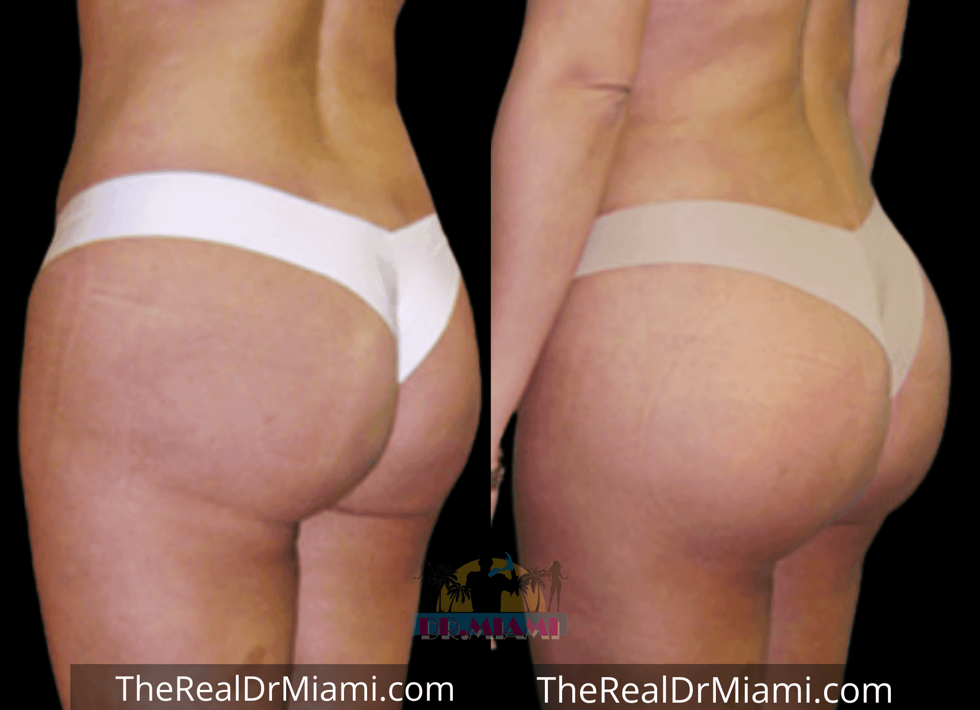 Before-and-after views for Brazilian Butt Lift, Case 72.