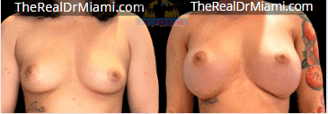 Before-and-after views for Breast Augmentation, Case 55.