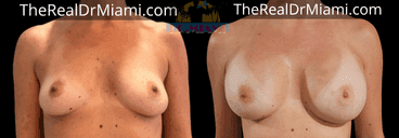 Before-and-after views for Breast Augmentation, Case 68.