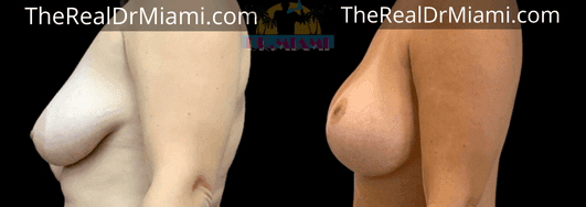 Before-and-after views for Breast Lift, Case 92.