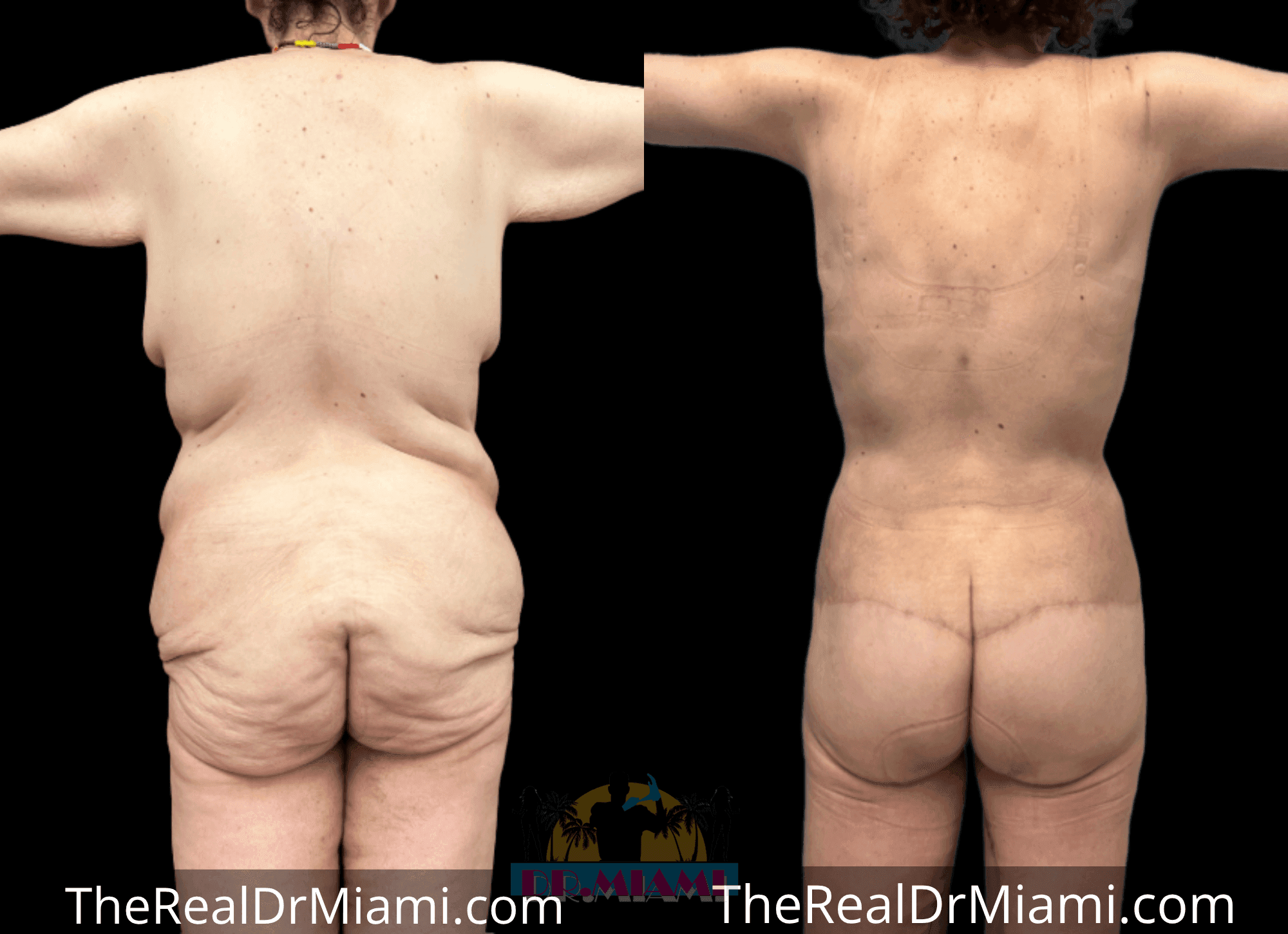 Before-and-after views for Massive Weight Loss, Case 23.