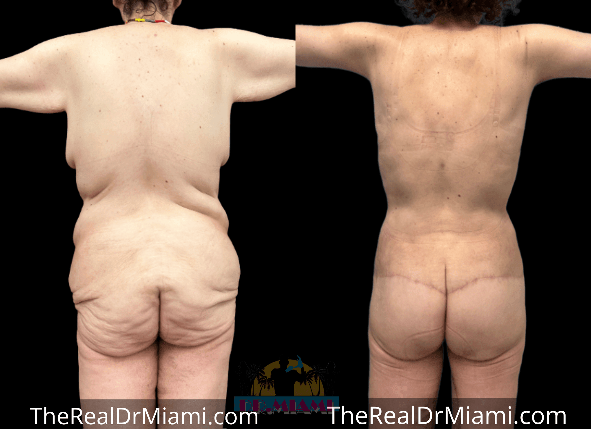 Before-and-after views for Massive Weight Loss, Case 23.