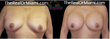Before-and-after views for Breast Augmentation, Case 2.