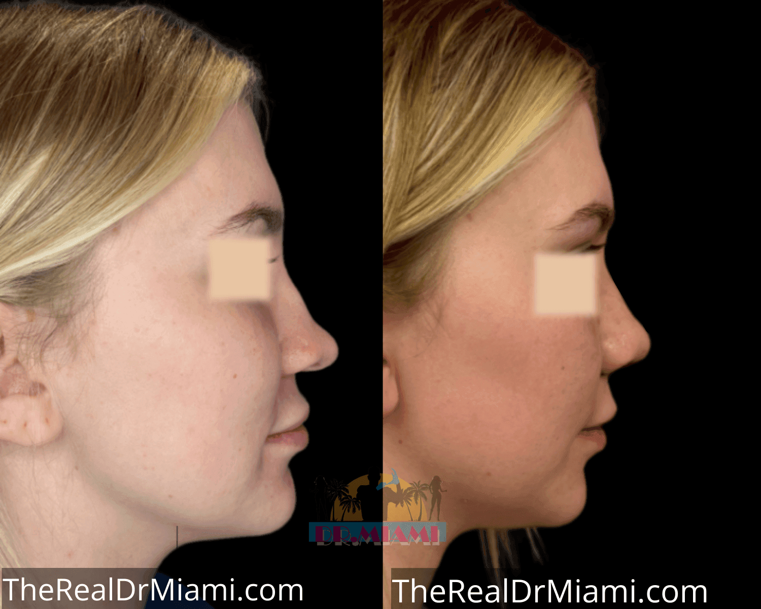 Before-and-after views for Rhinoplasty, Case 38.