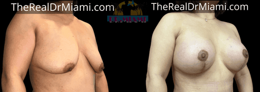Before-and-after views for Breast Lift, Case 54.