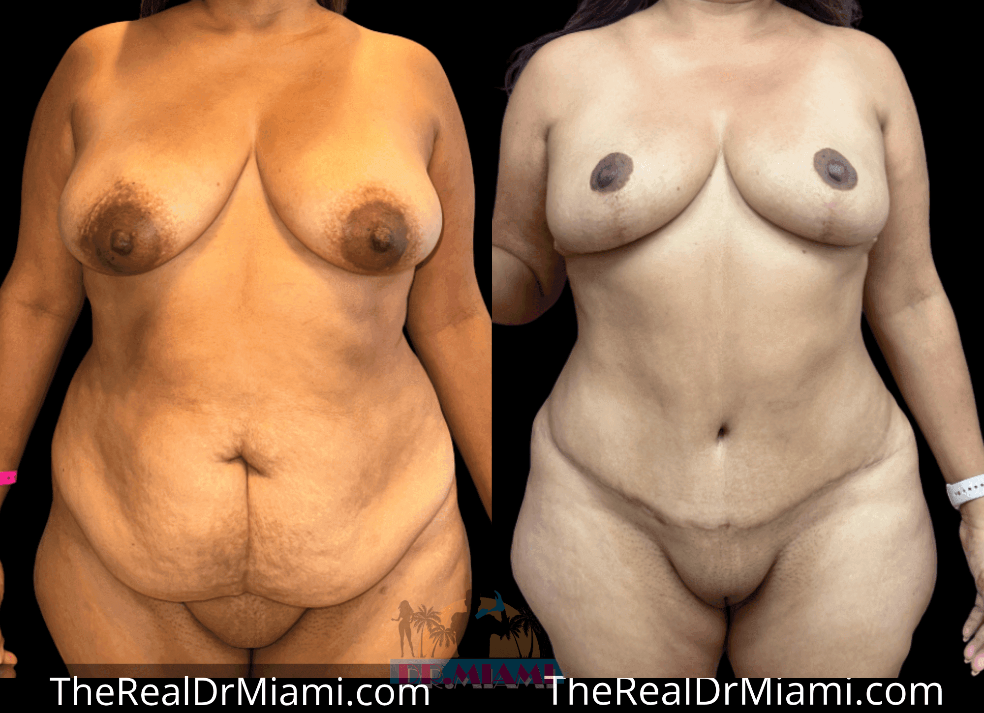 Before-and-after views for Massive Weight Loss, Case 7.