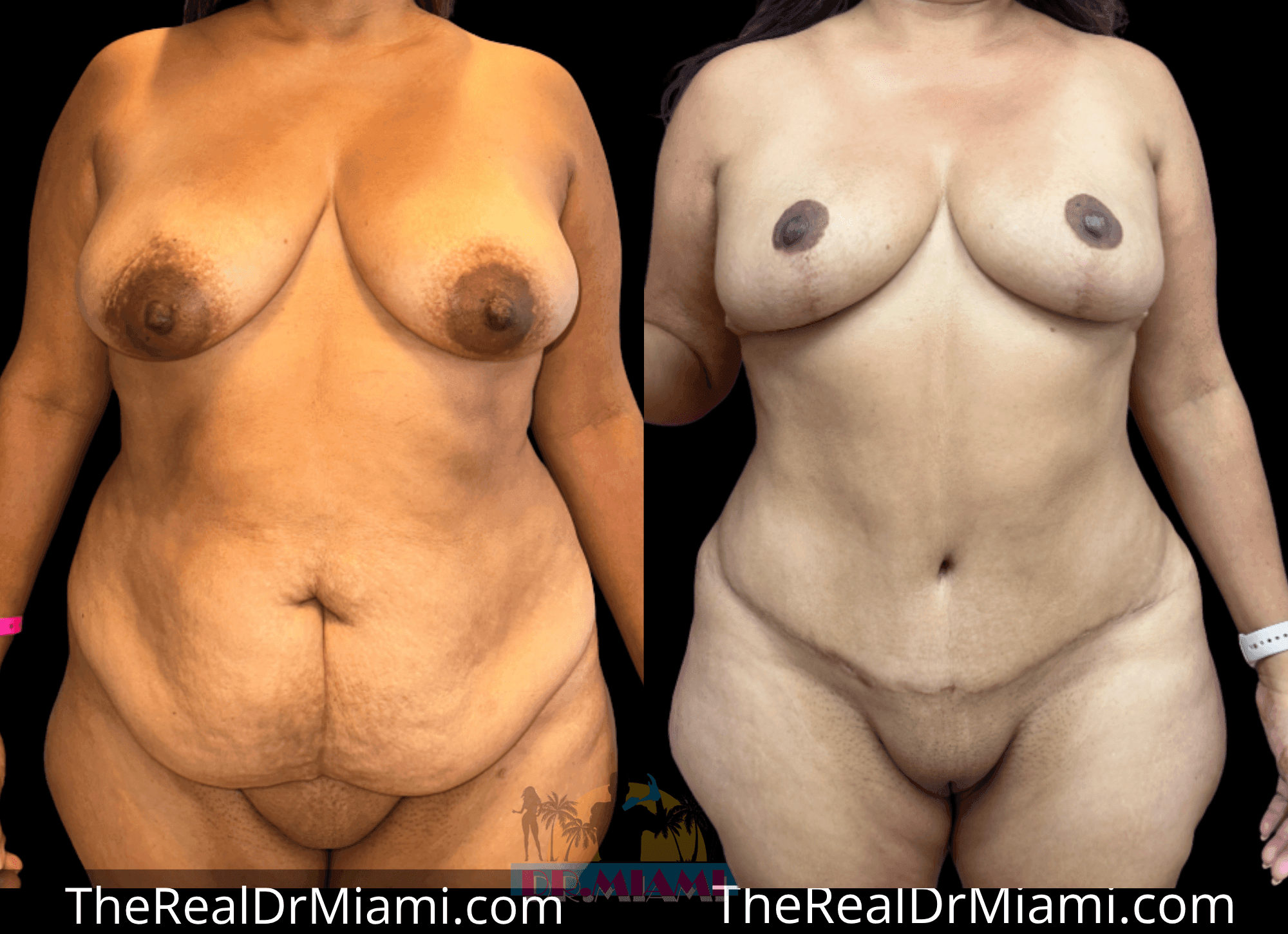 Before-and-after views for Massive Weight Loss, Case 7.
