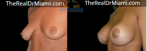 Before-and-after views for Breast Augmentation, Case 110.