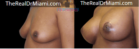 Before-and-after views for Breast Augmentation, Case 92.