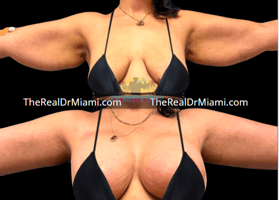 Before-and-after views for Upper Arm Lift, Case 12.