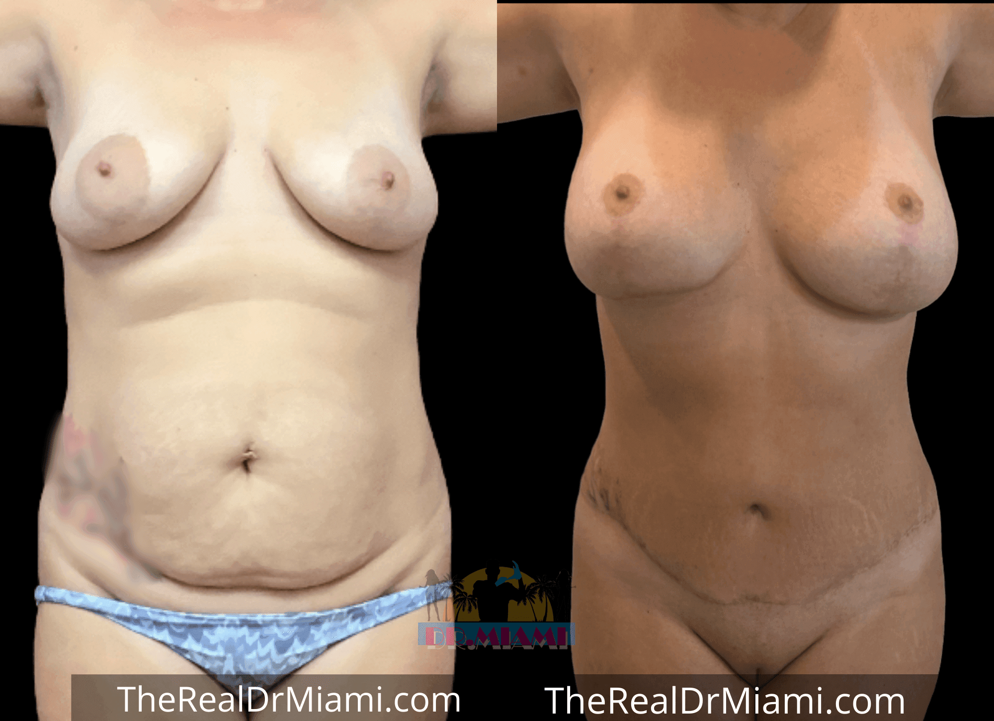 Before-and-after views for Mommy Makeover, Case 28.