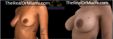 Before-and-after views for Breast Augmentation, Case 10.