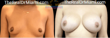 Before-and-after views for Breast Augmentation, Case 19.