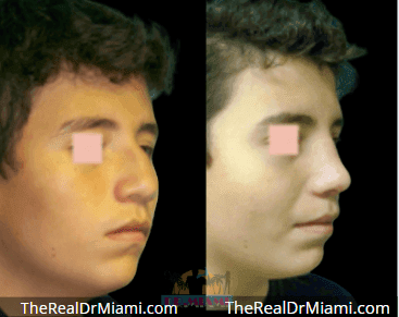 Before-and-after views for Rhinoplasty, Case 90.
