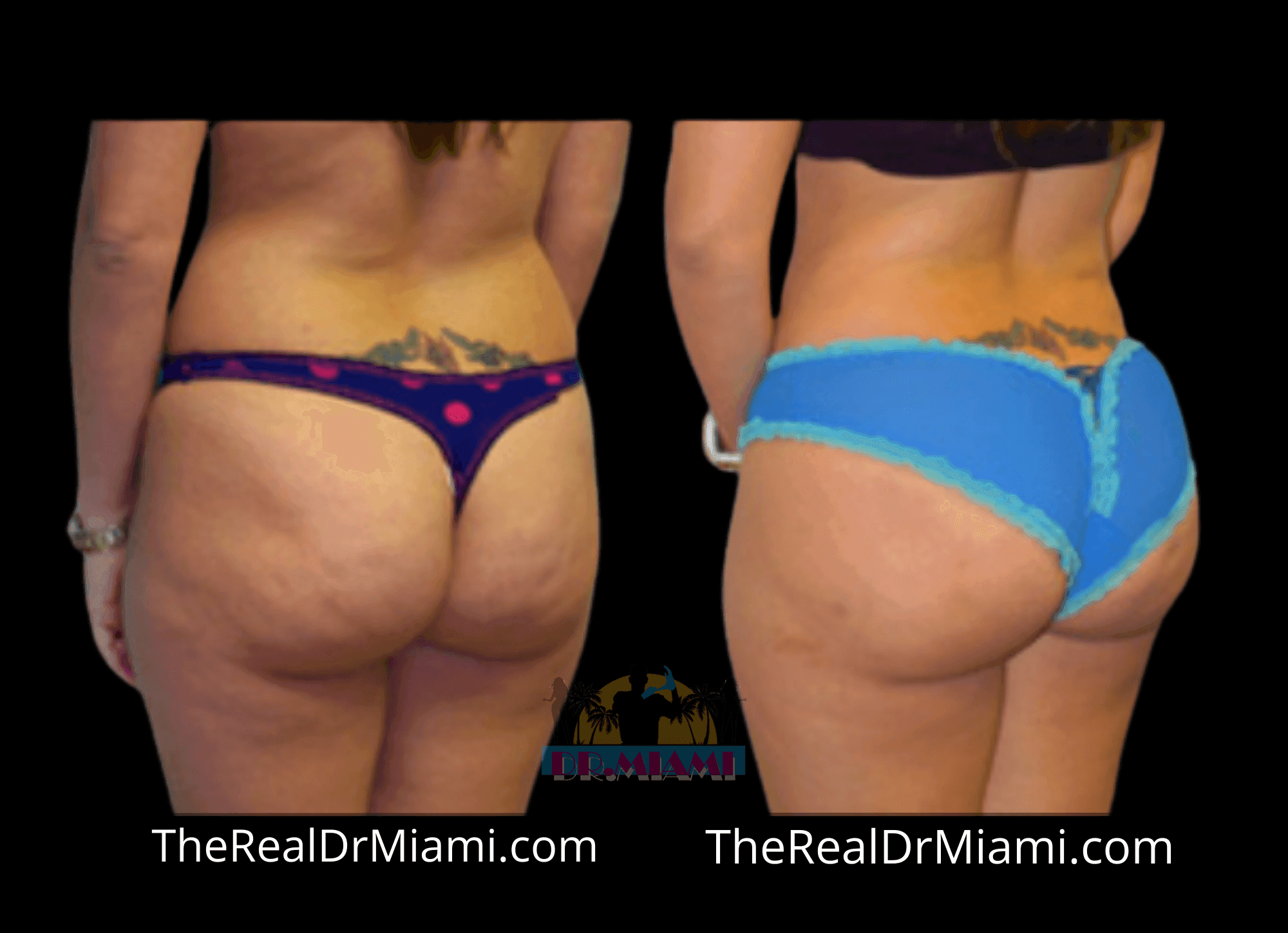 Before-and-after views for Brazilian Butt Lift, Case 56.