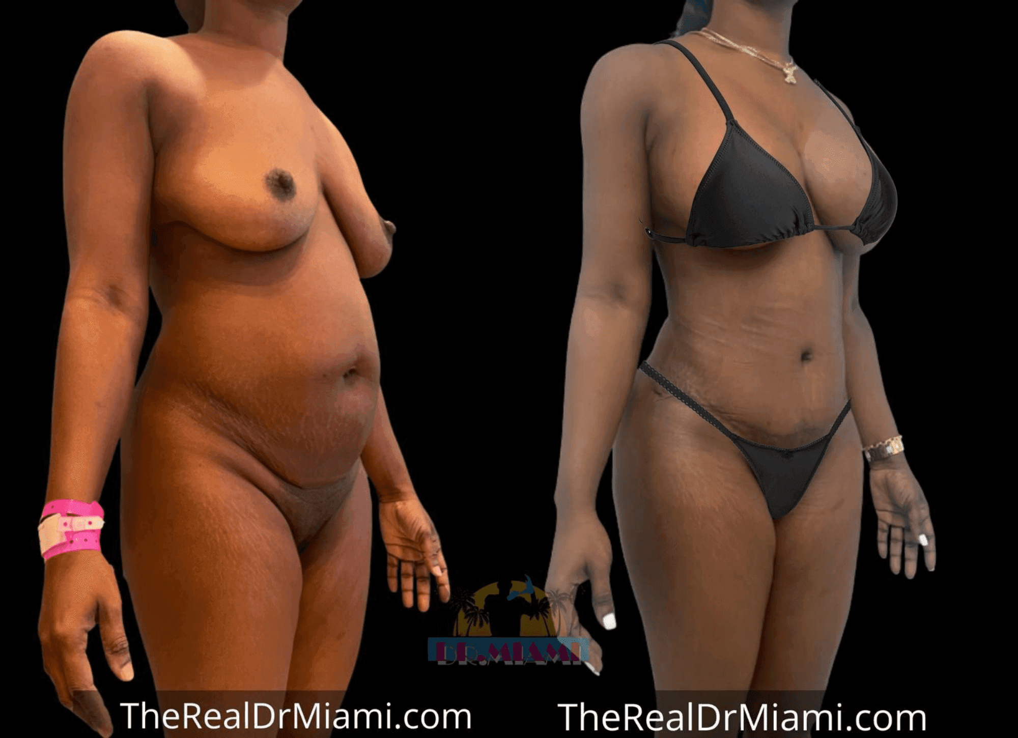 Before-and-after views for Mommy Makeover, Case 53.