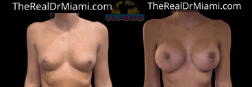 Before-and-after views for Breast Augmentation, Case 90.