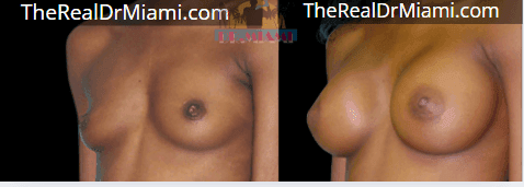 Before-and-after views for Breast Augmentation, Case 93.