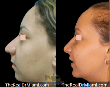 Before-and-after views for Rhinoplasty, Case 80.