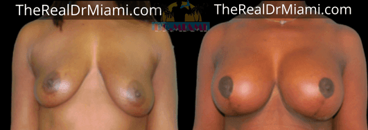 Before-and-after views for Breast Lift, Case 22.