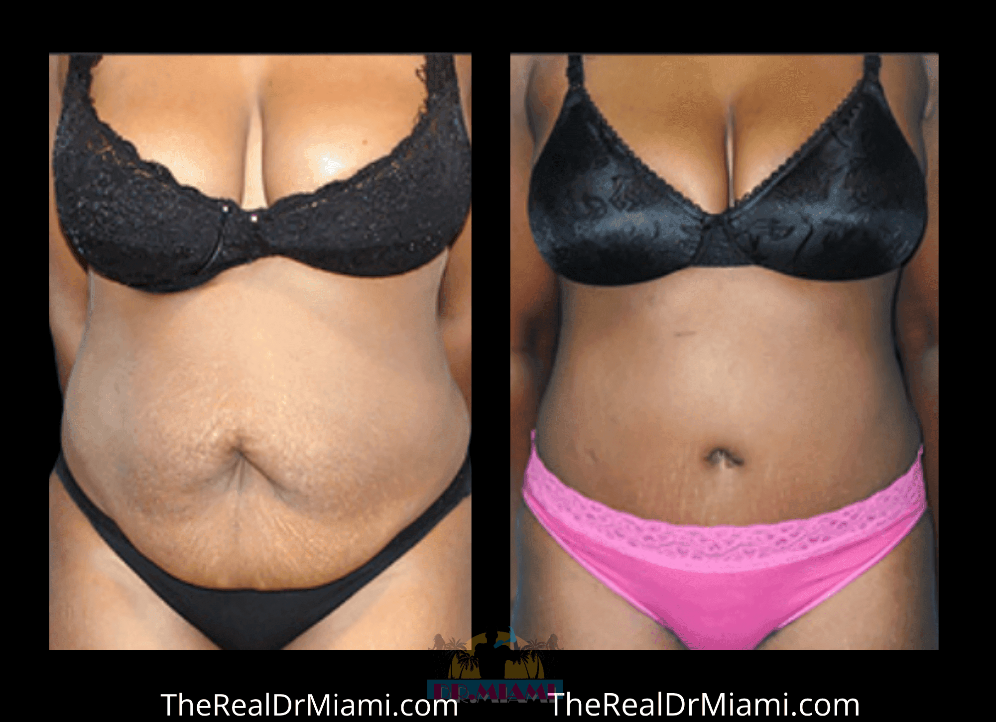 Before-and-after views for Tummy Tuck, Case 82.