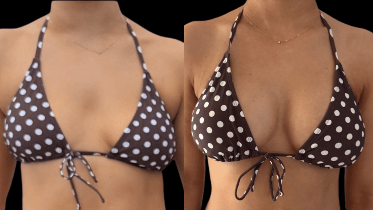 Before-and-after views for Breast Augmentation / Lift, Case 3 from The Next Dr. Miami collection.