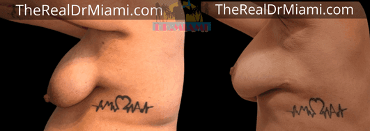 Before-and-after views for Breast Lift, Case 83.
