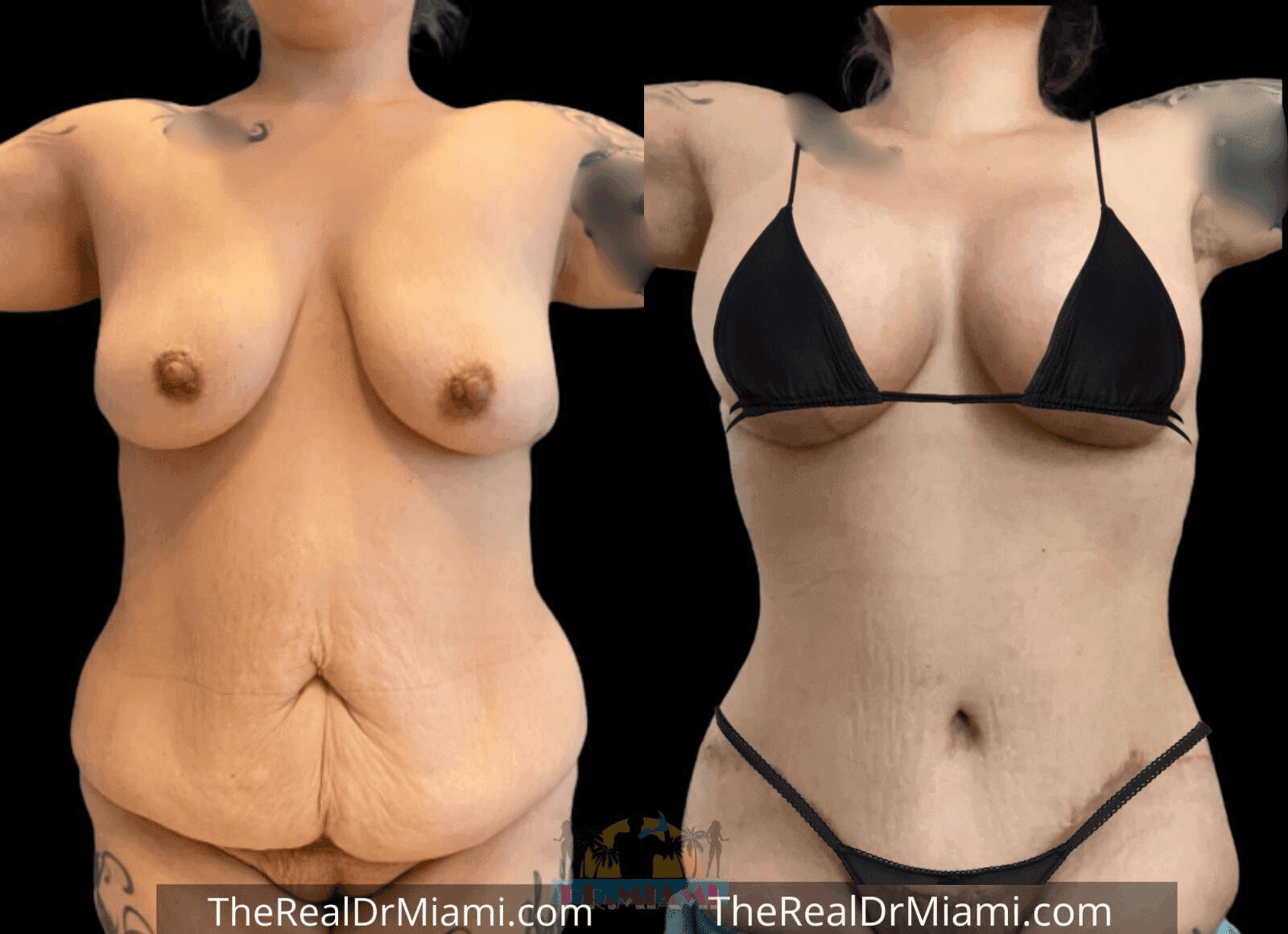 Before-and-after views for Mommy Makeover, Case 69.