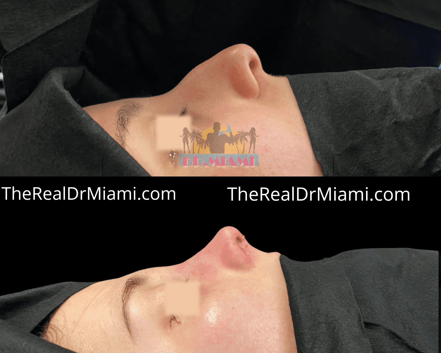 Before-and-after views for Rhinoplasty, Case 31.