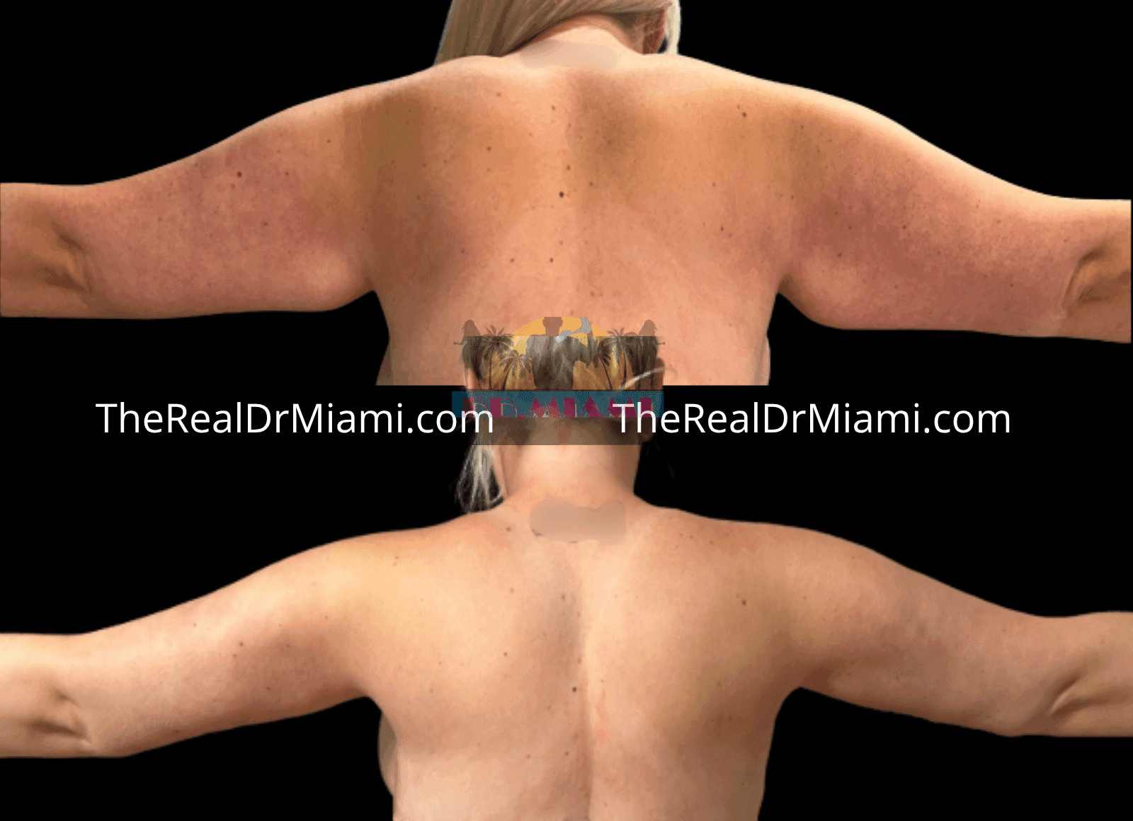 Before-and-after views for Upper Arm Lift, Case 6.