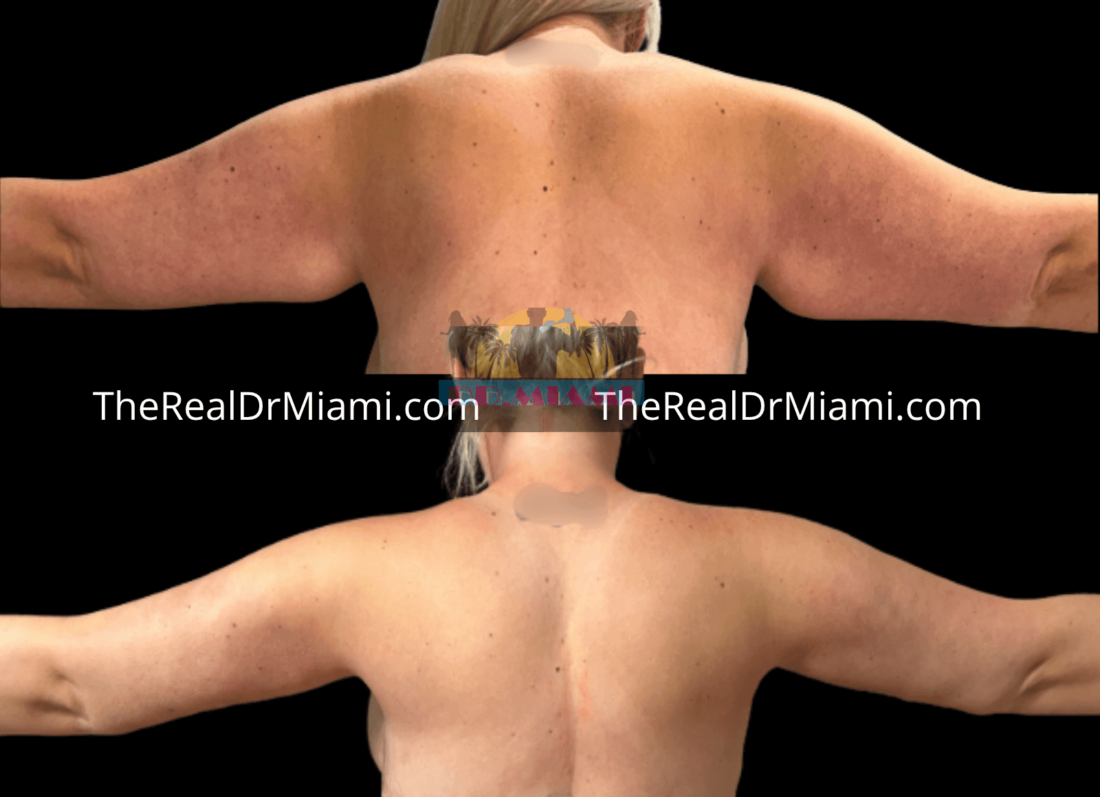 Before-and-after views for Upper Arm Lift, Case 6.