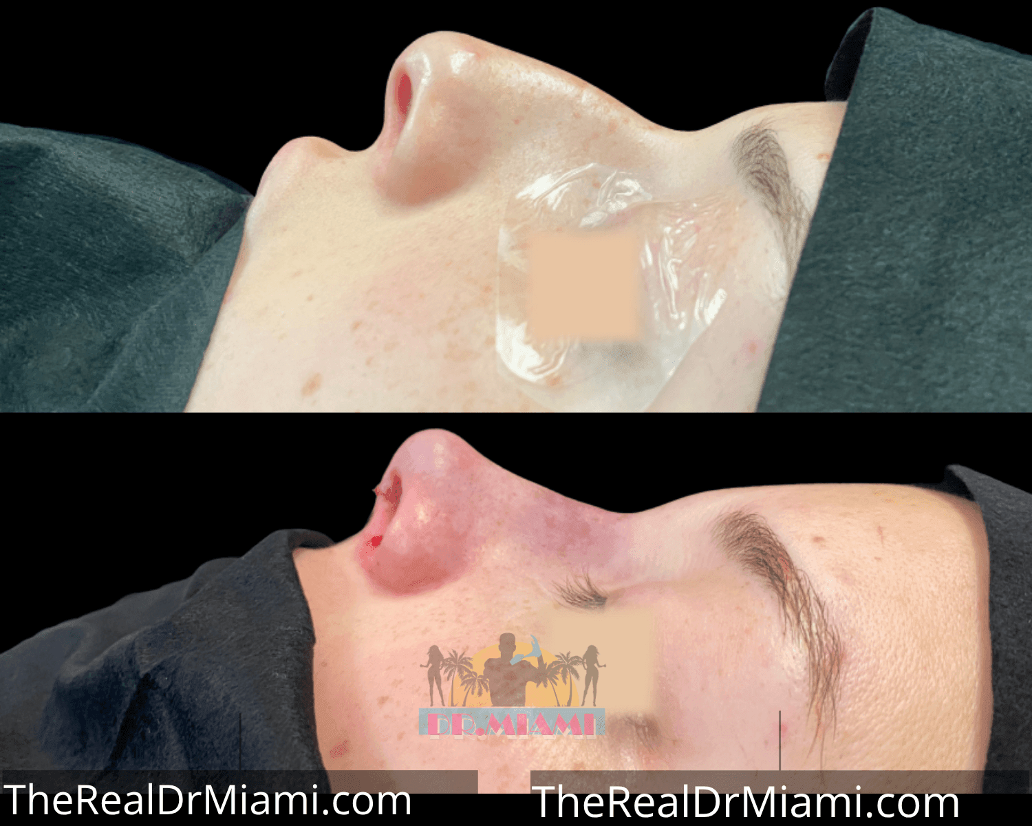 Before-and-after views for Rhinoplasty, Case 19.