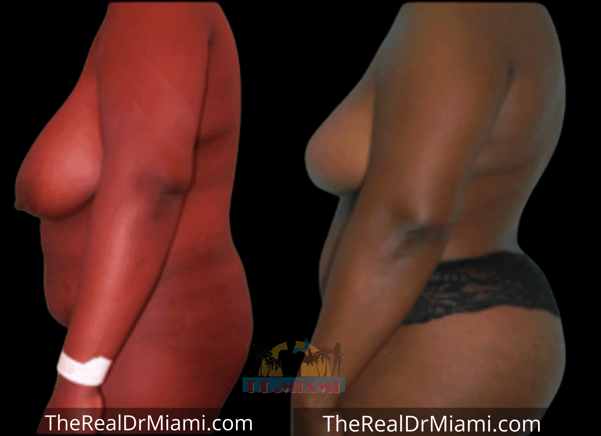 Before-and-after views for Brazilian Butt Lift, Case 37.