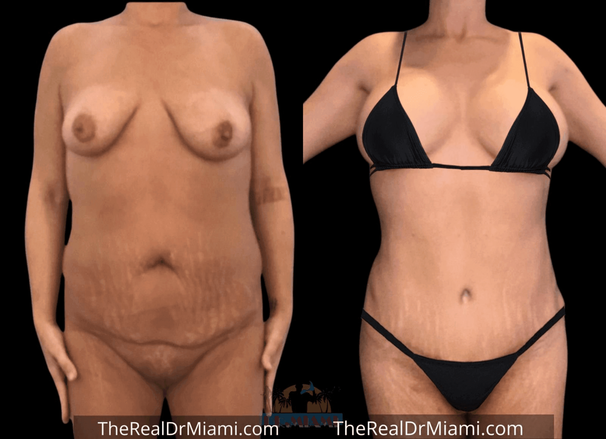 Before-and-after views for Mommy Makeover, Case 66.