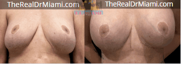 Before-and-after views for Breast Augmentation, Case 52.