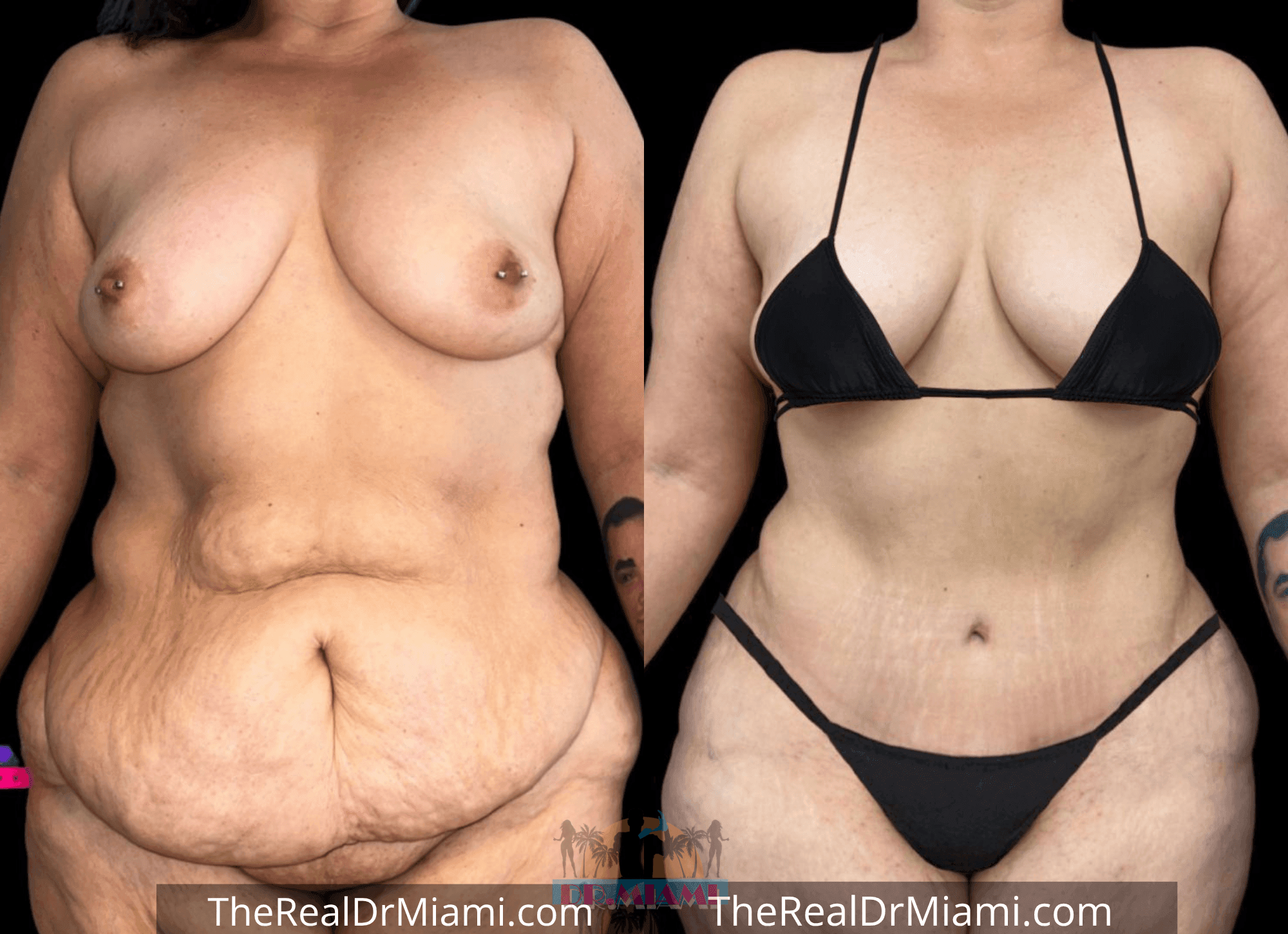 Before-and-after views for Tummy Tuck, Case 19.