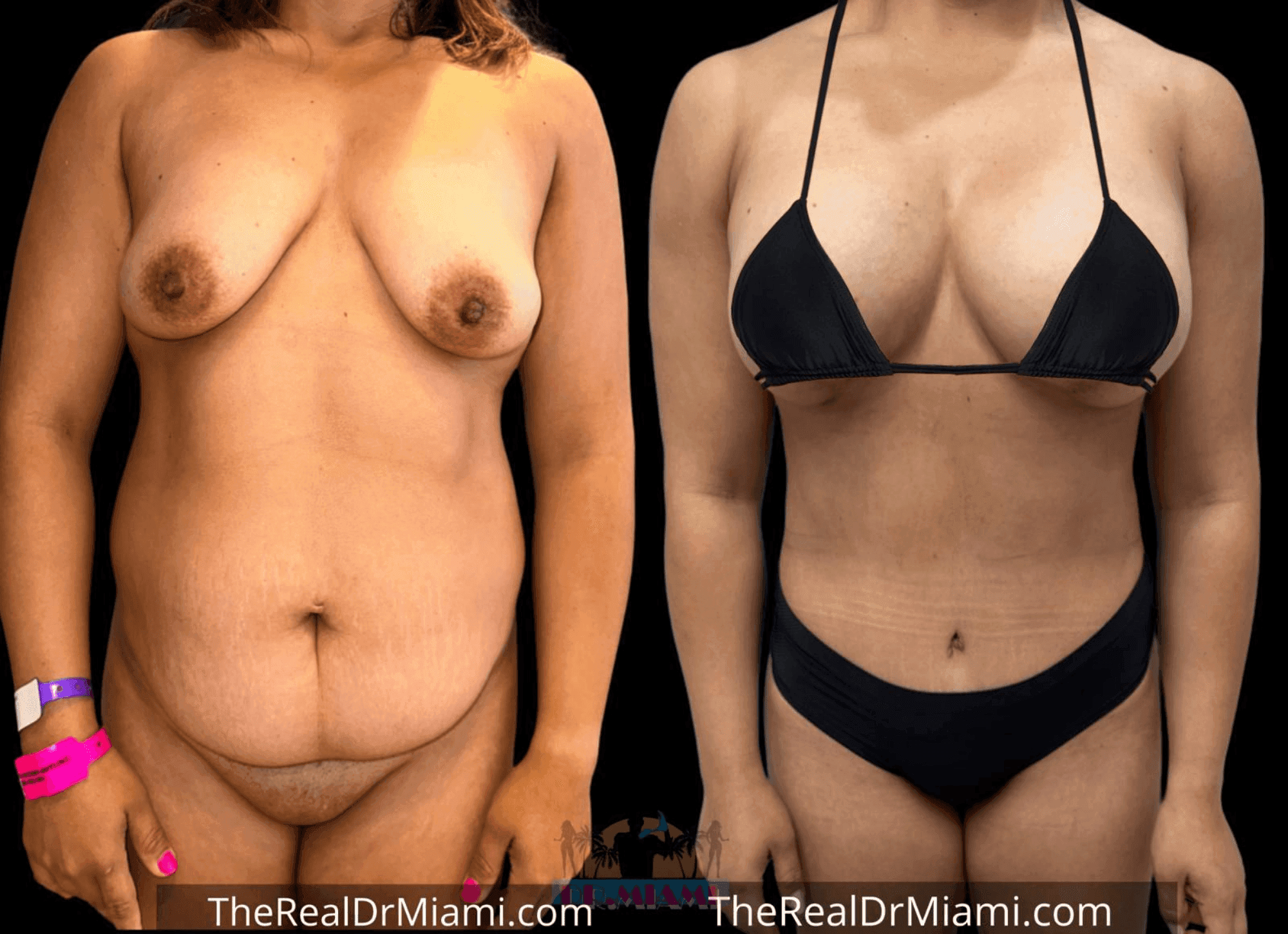 Before-and-after views for Tummy Tuck, Case 34.