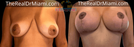 Before-and-after views for Breast Lift, Case 21.
